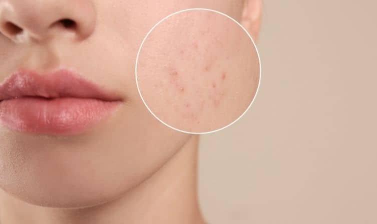 Spot Treatment Skincare Routine For Women